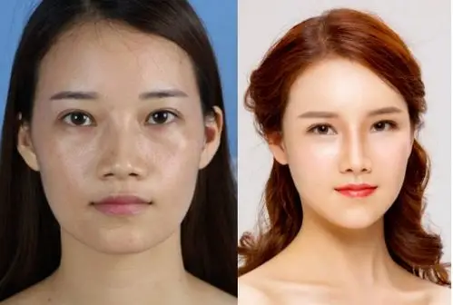 广州美莱整形真人案例vicky整形前后对比