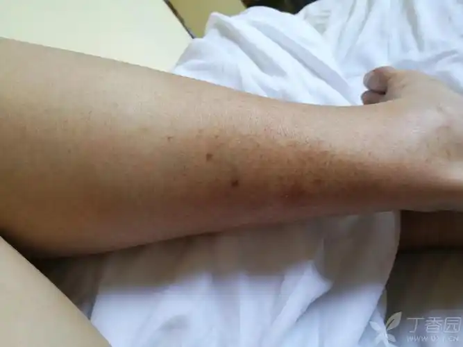 小腿出现斑纹 - 皮肤与性传播疾病讨论版 -丁香园论坛