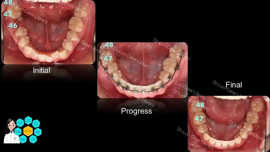 下颌第一磨牙拔除下颌磨牙替代案例分享