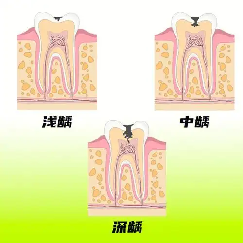 做牙齿隐形矫正前需要先治疗蛀牙吗71