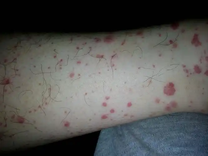 小腿红斑原先只有几个这两天变得很多不碰不痒略有突起感