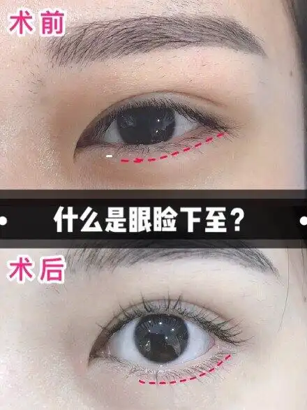 什么是眼睑下至究竟有何魅力能让众多日本女星都钟爱它