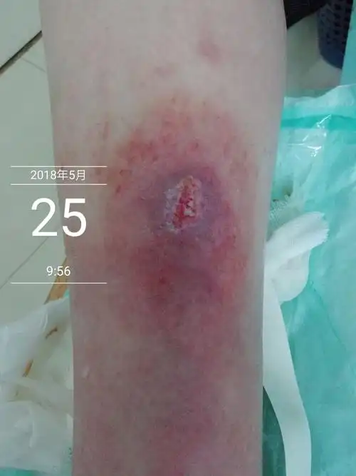 伤口结痂就一定愈合了吗?