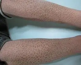 中医巧治鱼鳞病——还皮肤健康本色!_治疗