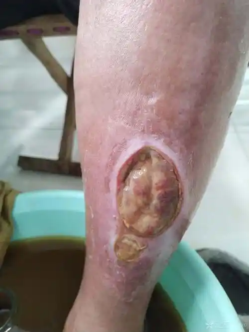 胫前外伤后感染皮肤缺损