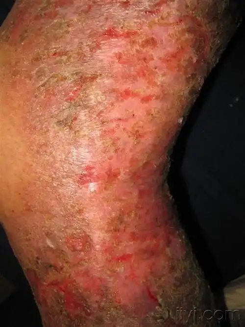 右下肢大面积湿疹,瘙痒,2年 - 皮肤及性传播疾病讨论版 - 爱爱医医学