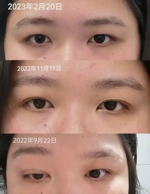 重症肌无力治疗4个月