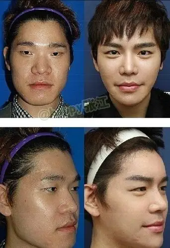 韩国屌丝男辛酸整容史挨50刀大叔变美男组图