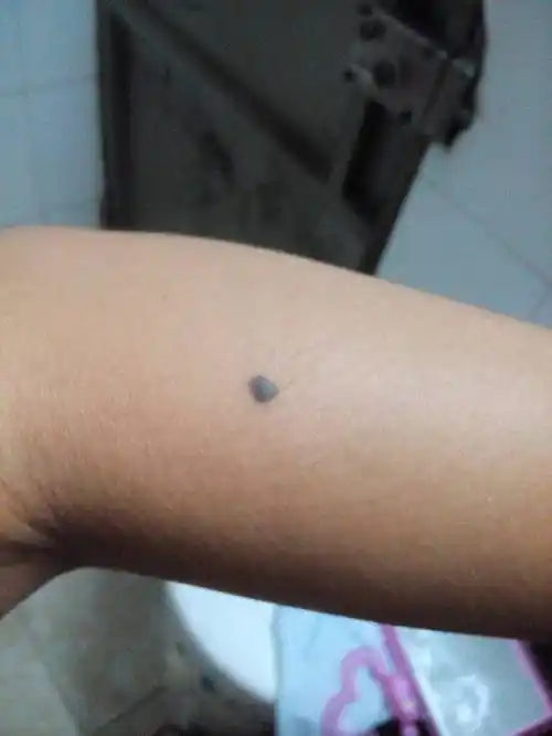 辐射等外因引起的,属于皮肤病的一种女人手臂各种痣图解影响美观其实"