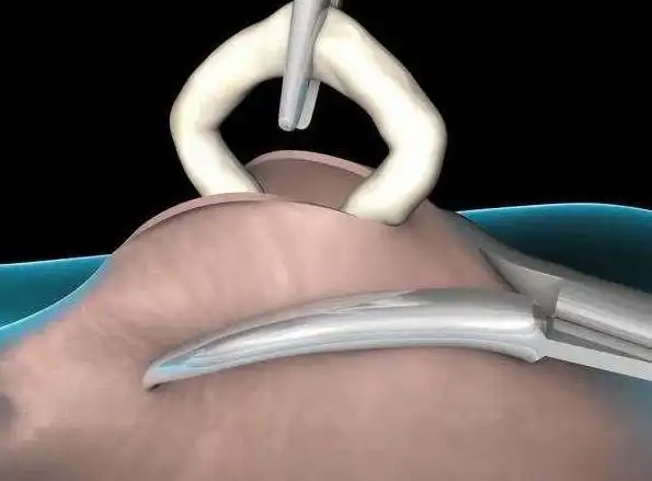 男性结扎还是女性上环听听医生怎么说