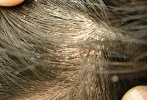 如果你有头屑,头痒,头癣,请耐心看完