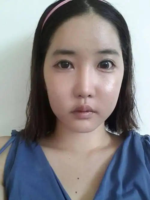 看到自体脂肪面部填充失败的人,真的非常心痛