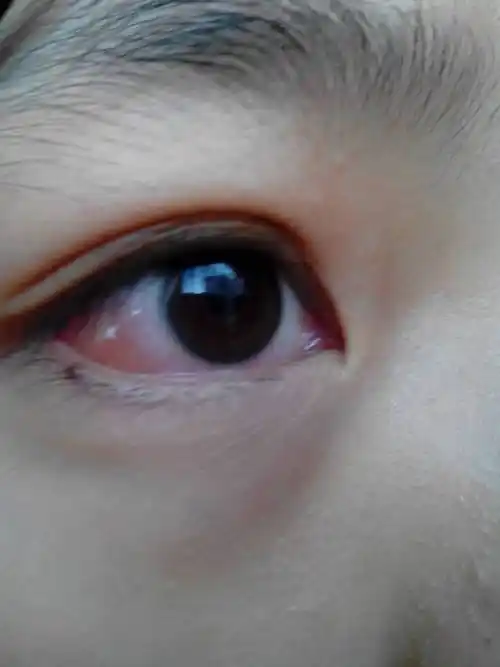 眼睛这样是怎么回事?昨天还好好的,会不会之前吃太多辣的导致上火