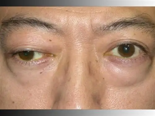 重症肌无力碧螺春