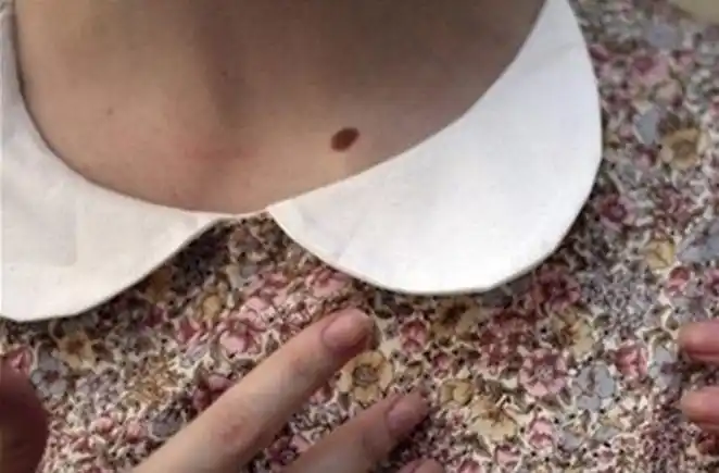 痣相看运势:朱砂痣与守宫砂解读人生运势,你的身上有没有