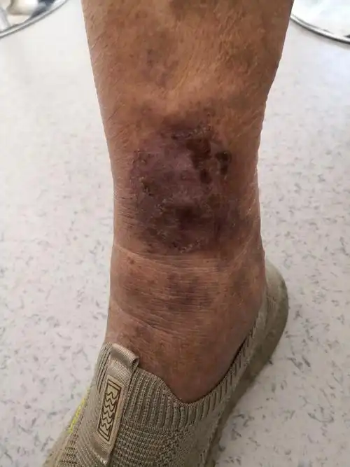 解决皮肤问题专注皮肤美容##湿疹