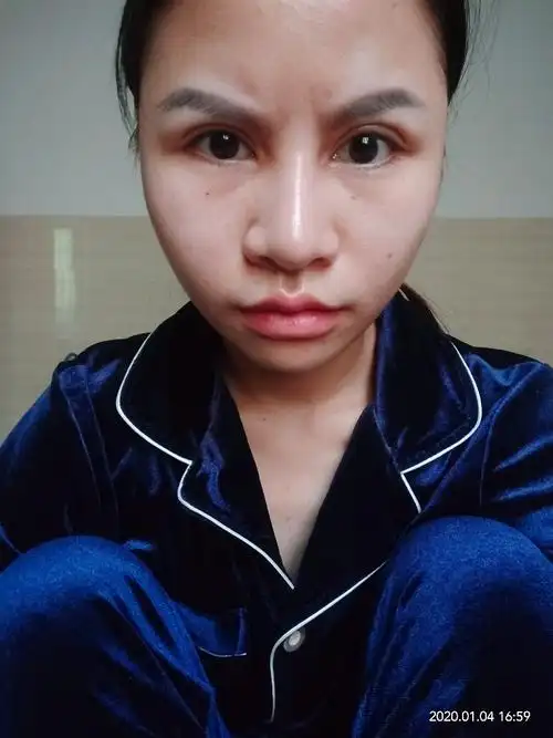 割完双眼皮四,好显老