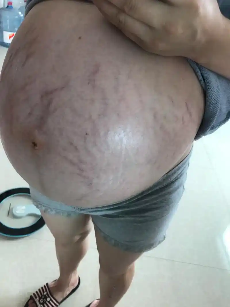 从怀孕20周开始走路久了就容易肚子发硬有下坠的感觉,现在孕3 - 抖音