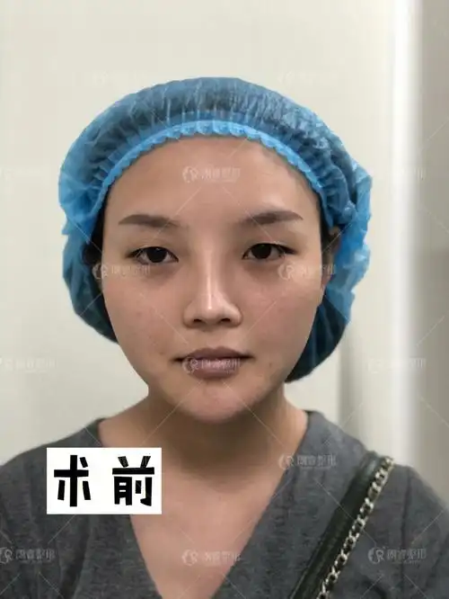 欧式双眼皮案例——朗睿整形