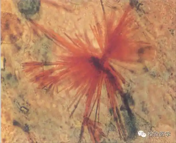 酪氨酸结晶↑亮氨酸结晶↑磷酸钙结晶↑尿酸结晶↑三联磷酸盐结晶