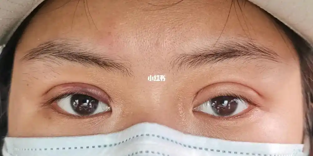 埋线双眼皮,五点定位双眼皮第二天_双眼皮_埋线双眼皮_消炎_头孢_美妆