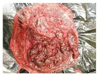 胎盘厚薄不均,最薄处如纸,缺乏绒毛组织,面积较大(图片来源:参考文献