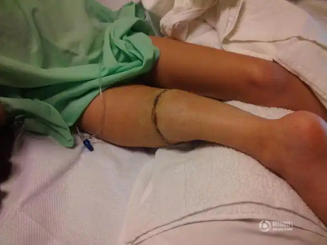 女生换义肢跳芭蕾诠释永不言弃 感动师生