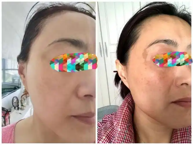 nuskin使用前后皮肤对比汇总(更新中)