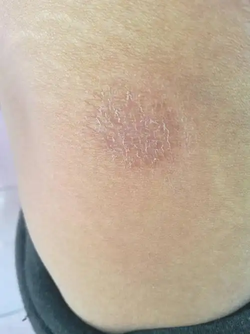 请我我这是什么癣了?该用什么药?