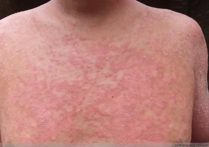 转载奇方神水身上奇痒患湿疹一摸就除根