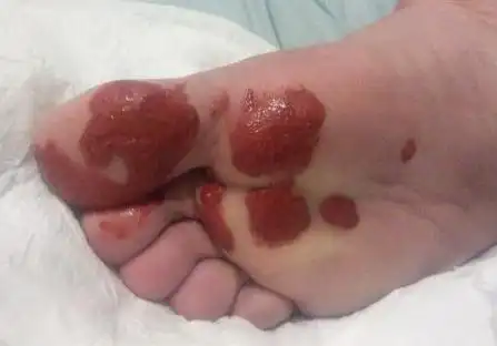 梦见脚底受伤而流血