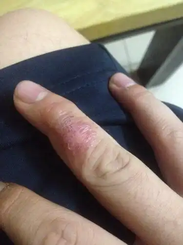 知情的能不能告诉一下手指上那是什么病吗