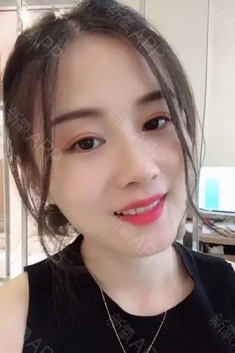 双眼皮术后都会出现哪些并发症,应该怎么处理?