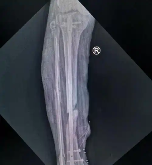 车祸多处骨折 必须截肢?沈积专家保住了他的腿