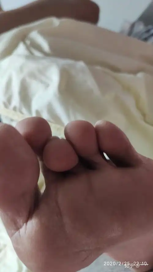 脚中指弯曲有办法么