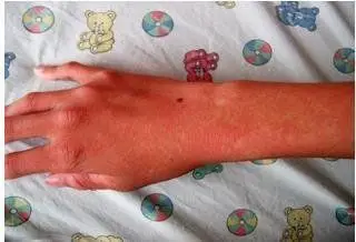 登革出血热_疾病库_疾病查询_疾病大全_就医160网_网上预约挂号统一