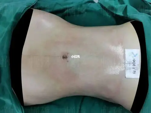 女性的腰腹是最容易囤积脂肪的部位,纯脂肪足够多因此吸脂效果很明显!