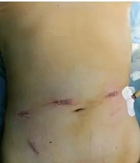 cscrs 2014:达芬奇机器人手术系统造福结直肠癌患者