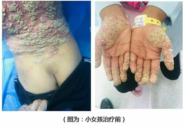 爱心除困境---(广南县皮防站免费为档卡户女孩治疗重症皮肤病)