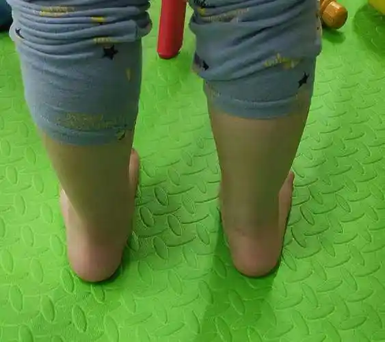走路外八字会导致什么腿型