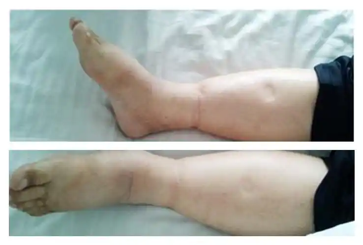 糖尿病肾病腿部水肿图片