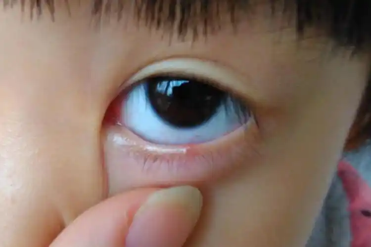 下眼睑里有小红点图