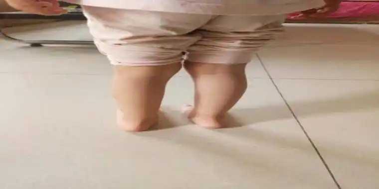 严重的内八字千万不要耽误要及时去医院进行矫正治疗妈妈们还可以给