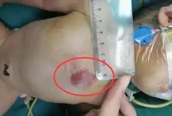 男婴天生玻璃心 胸骨裂发病率在新生儿中低于十万分之一