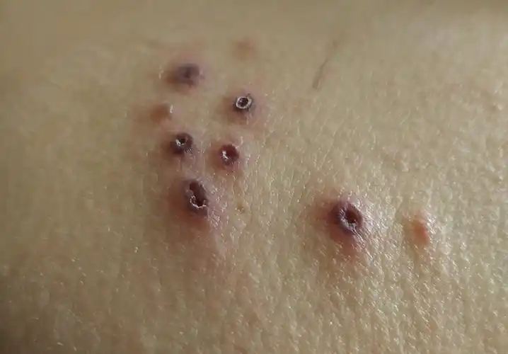 图片上是哪种皮肤病?_百度知道