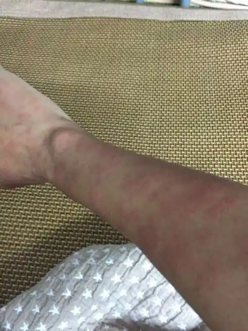 过敏性皮肤病高发季节 注意防护