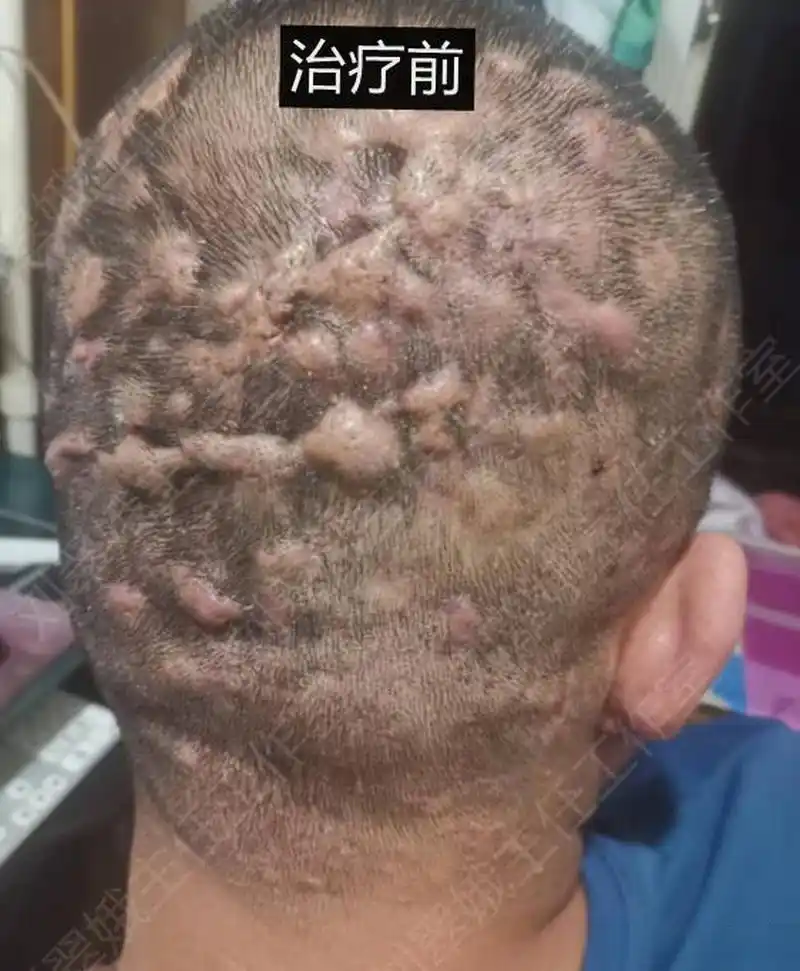 这位小伙子头上的毛囊炎疙瘩不断,非常难受.