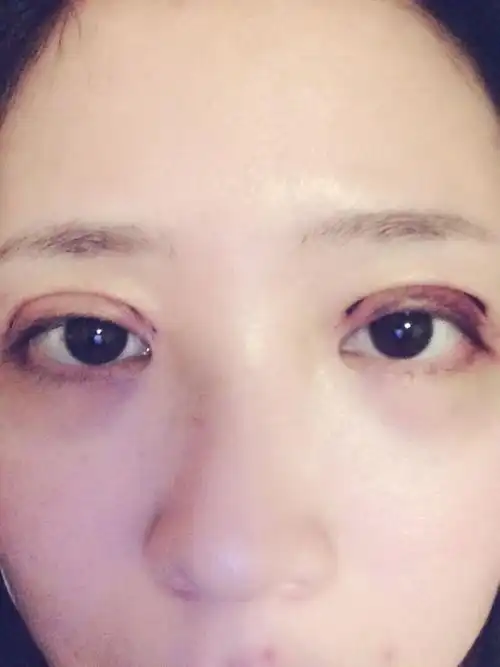 刚做完两天的双眼皮难看吗