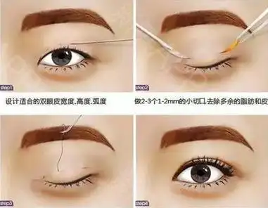 双眼皮埋线和全切双眼皮哪个更好?