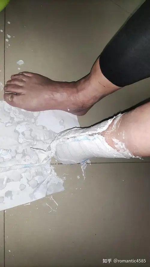 一例半足截肢患者制作硅胶拉链假肢的制作流程介绍